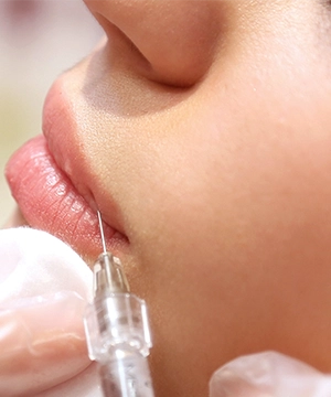 Lip flip and perioral Botox treatment to relax mouth muscles, refine lip shape, and soften fine lines