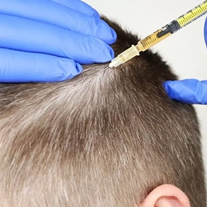 Tri-Cell PRP adds volume in mid-scalp region, perfect for hormonal hair fall and sparse spots.