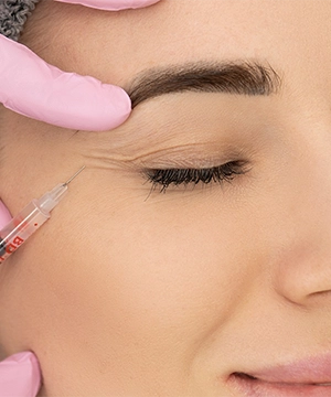 Crow’s feet Botox treatment to reduce fine lines near the eyes, keeping the area smooth and natural-looking