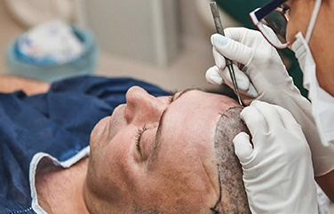 Achieve fuller, natural hair with advanced Sapphire FUE for painless, and long-lasting Results